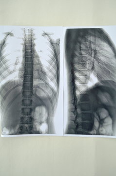 Рентген человеческого позвоночника - заключение врача, медецина