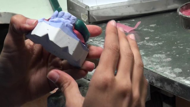 Dentist is applying hot wax into a mold. Dental technologist, the restorations may be formed directly in the mouth or may be cast using the lost-wax technique, such as for some inlays and onlays.