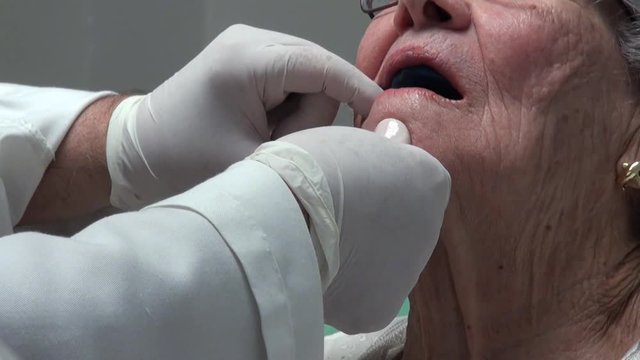 Dentist is applying dentures in elderly, when a tooth is lost, dentures, bridges, or implants may be used as replacements.