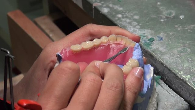 Dentist is applying hot wax into a mold. Dental technologist, the restorations may be formed directly in the mouth or may be cast using the lost-wax technique, such as for some inlays and onlays.