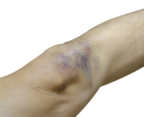Bruises on leg