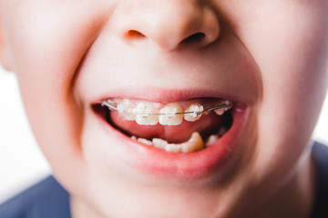 braces dental smile face teeth