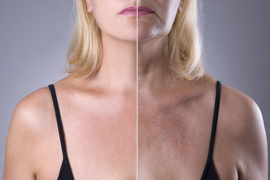 Rejuvenation woman's skin, before after anti aging concept, wrinkle treatment, facelift and plastic surgery