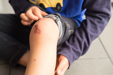 Wound on the knee of a small child