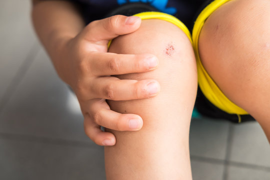 Wound On The Knee Of A Small Child