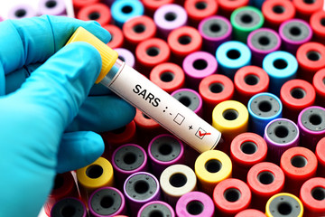 Blood sample positive with SARS virus - obrazy, fototapety, plakaty