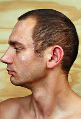 Obraz premium Man with infected skin on the face