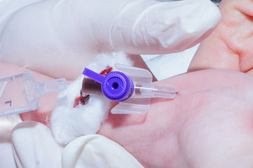 Intravenous catheterization of newborn baby close-up in neonatal intensive care unit
