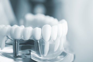 Dental teeth dentistry model - obrazy, fototapety, plakaty