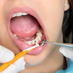 Interdental cleaning on human teeth.