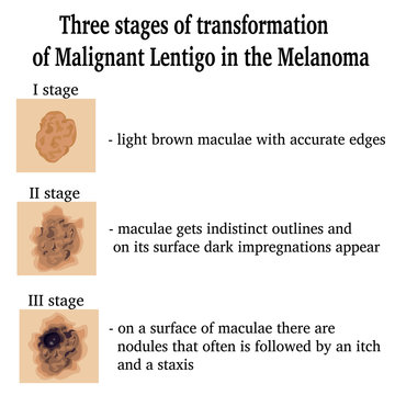 Three stages of transformation of Malignant Lentigo in the Melanoma
