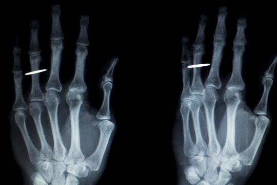 Hand fingers implant Xray scan