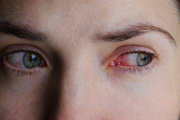 Closeup of irritated or infected red bloodshot eyes - conjunctivitis