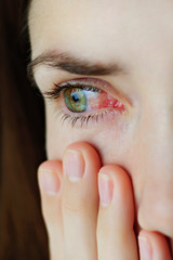 Closeup of irritated or infected red bloodshot eyes - conjunctivitis