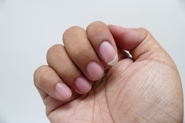 Close up of nail tear, feeling hurt finger