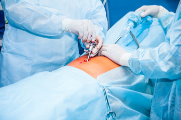 Complex laparoscopic operation on a peritoneal cavity is carried out in four hands