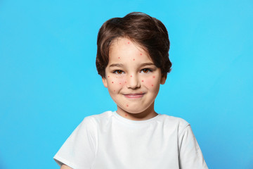 Little boy with red pimples on blue background. Chicken pox concept
