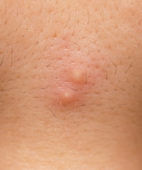 Fototapeta premium acne on the skin