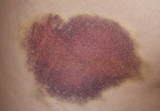 bruising on a skin - after trauma