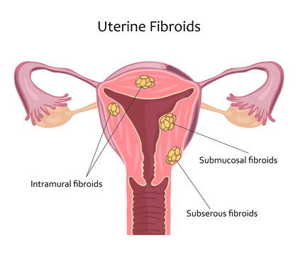 Uterine Fibroids Illustration