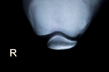 Orthopedics knee injury Xray scan