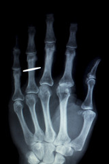 Hand fingers implant Xray scan