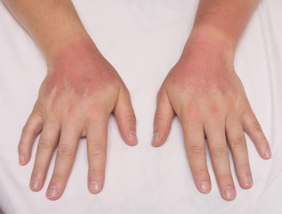 sunburn