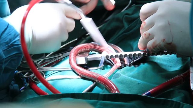 Open heart cardiac surgery in operation room