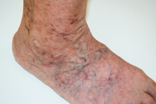 Disease varicose veins from an old man