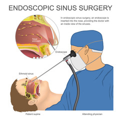Endoscopic sinus surgery.