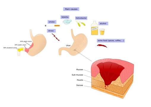 stomach ulcer, main causes