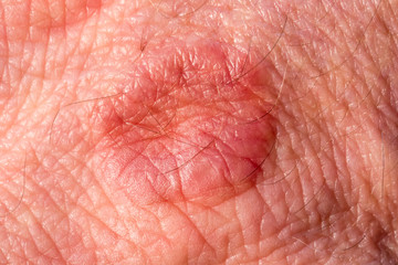 Haut mit Ausschlag / Ekzem