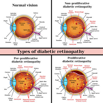 Types of diabetic retinopathy: non-proliferative, pre-proliferative diabetic retinopathy, proliferative retinopathy of retina.