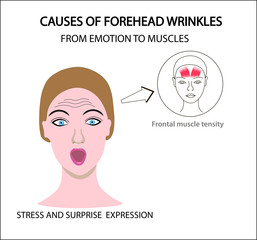 Женское лицо с мимическими морщинами и складками. Схематическое изображение напряженных лицевых мышц