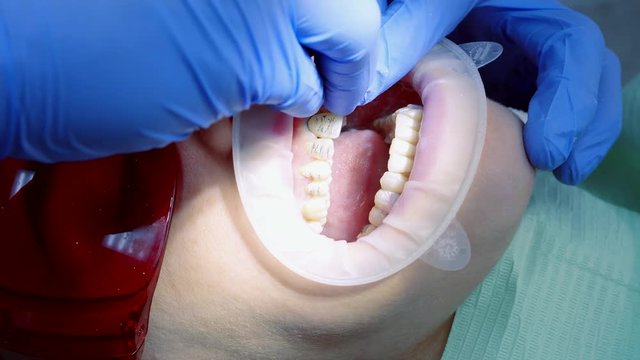 Close-up mouth of the patient and the hands of the doctor with the tool puts the thread to fix the gums and stop the bleeding.