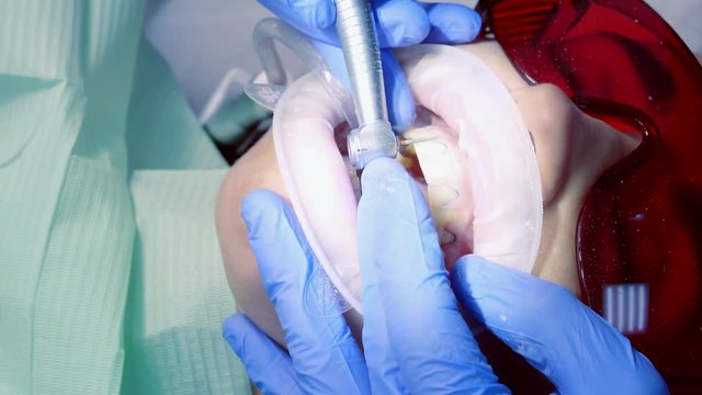 Close-up of a girl with a expander mouth at the dental clinic. A young girl in a modern dental office.