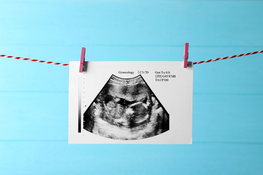 Ultrasound of baby hanging on rope