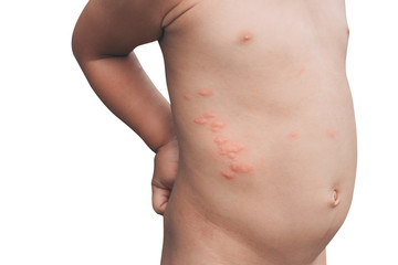 Boy with multiple and insect bites on body on white background