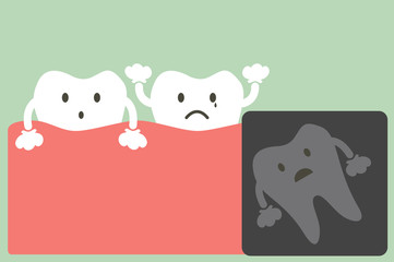 x-ray wisdom tooth