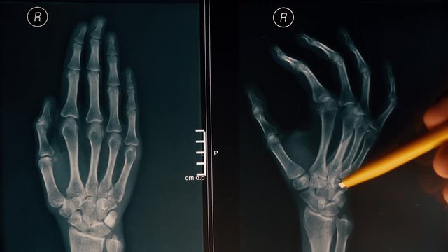 Doctor explains xray image of a hand to a patient. 4K close-up shot