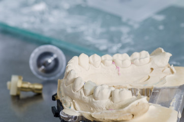 Hybrid ceramic crown in a dental cast model