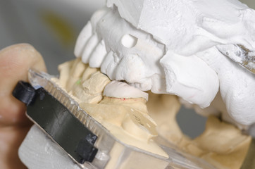 Dental technician putting a ceramic tooth in a dental cast model