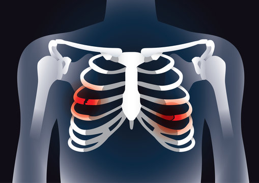 Red signal at the bones in rib cage break. Illustration about damage inside body.