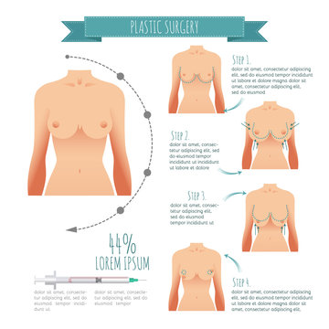 Plastic Surgery Illustrations. Breast Augmentation, Breast Lift