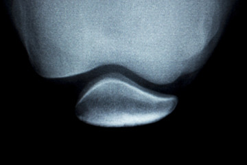 Orthopedics knee injury Xray scan
