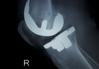 Orthopedic knee implant Xray scan