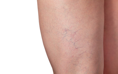 Varicose veins and capillary veins in the legs. Medical inspection and treatment of Telangiectasia.