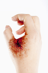 Artificial Blood Wound on Human Hand - 137179536