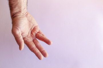 Hand of an man with Dupuytren contracture  disease, against  bright background  