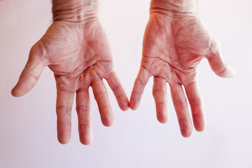 Hands of an man with Dupuytren contracture disease  against  bright background